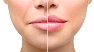 فیلر لب ارومیه